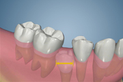 Early Loss of Primary Teeth (alt)